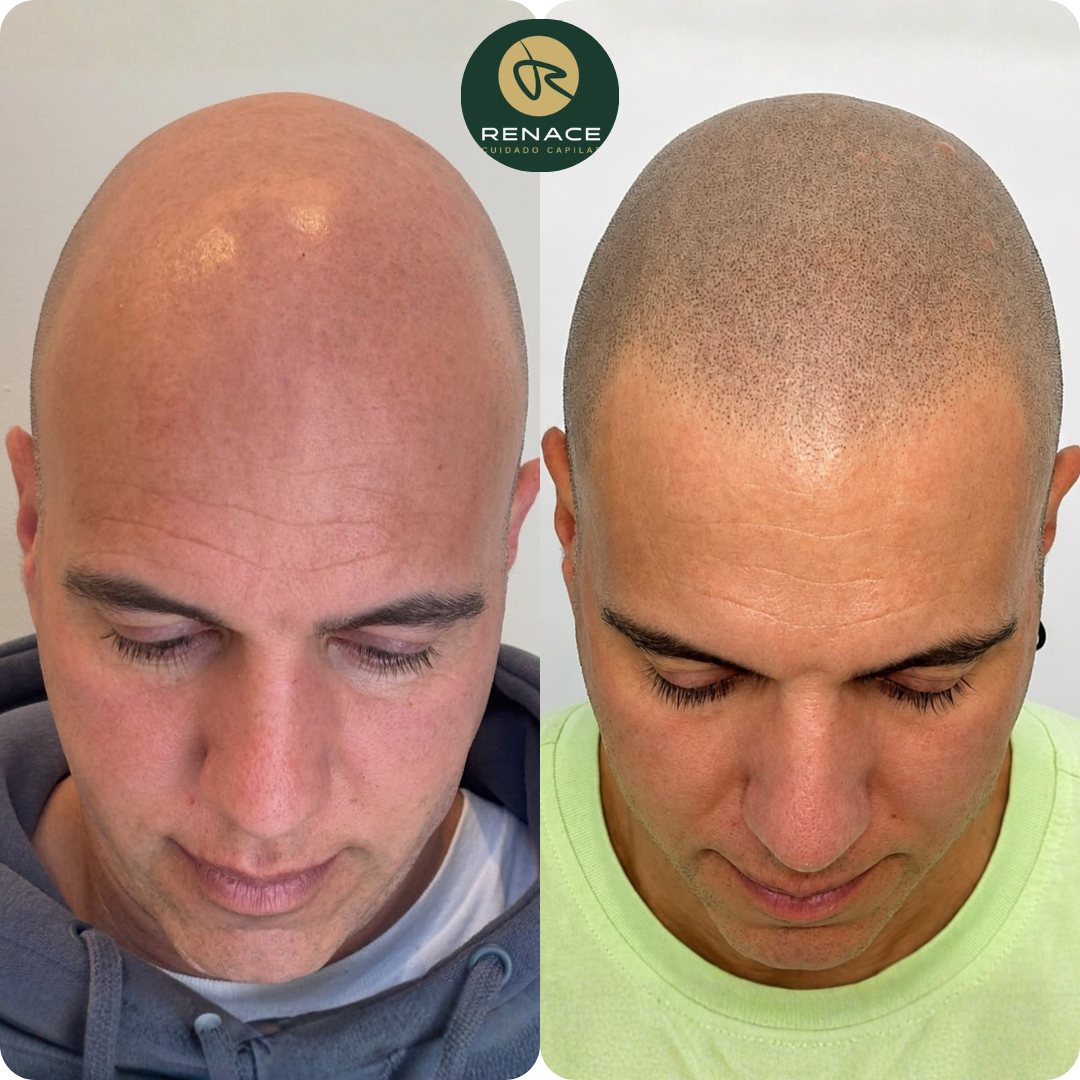 Antes y después micropigmentación capilar — caso real 8