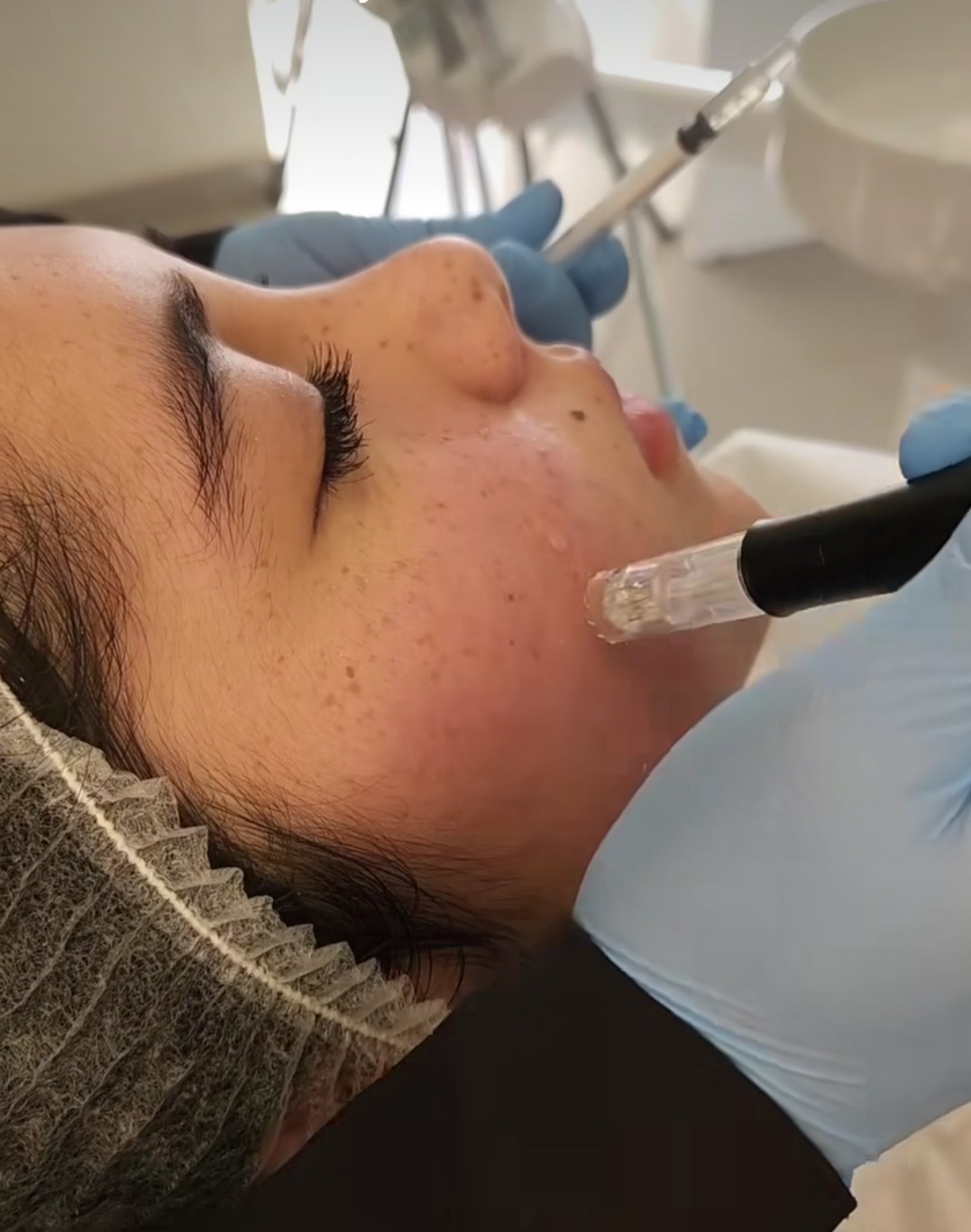 Mesoterapia con Dermapen