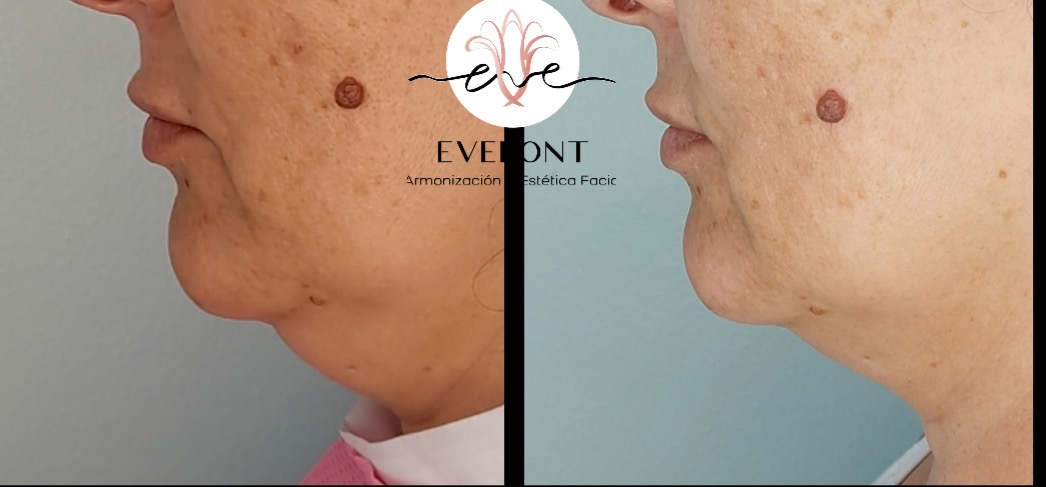 Lipolíticos Faciales