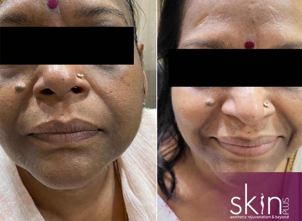 Dark spots &middot; laser treatment