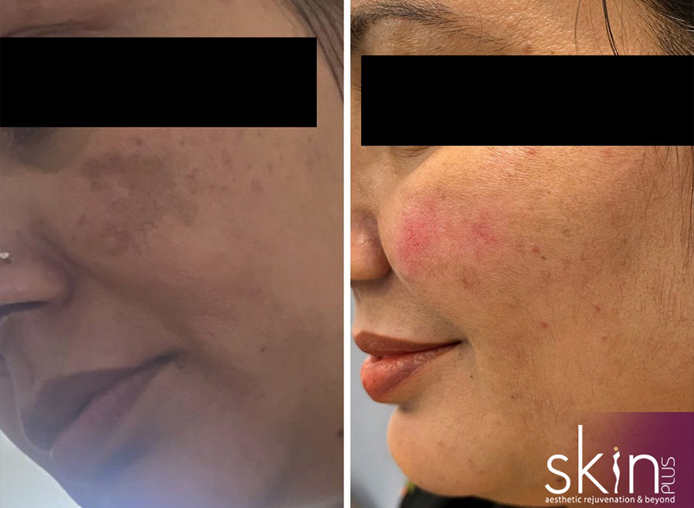 Pigmentation &middot; before & after