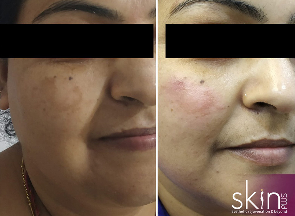 Pigmentation &middot; before & after