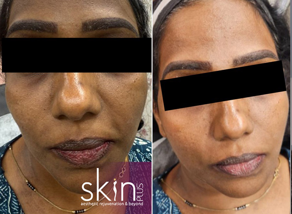 Pigmentation &middot; before & after