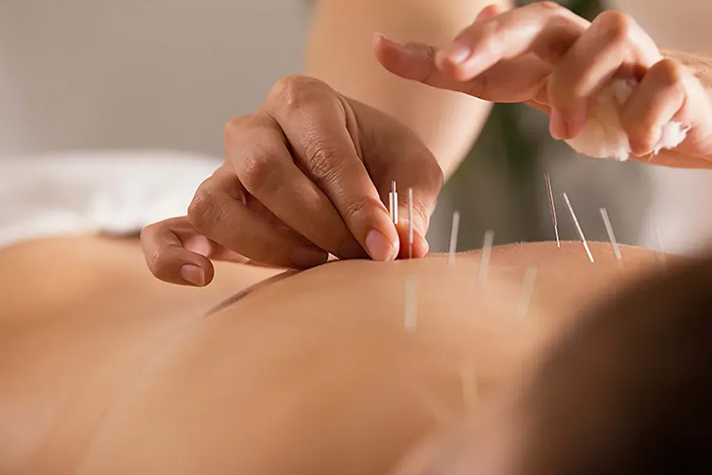 Patient receiving acupuncture