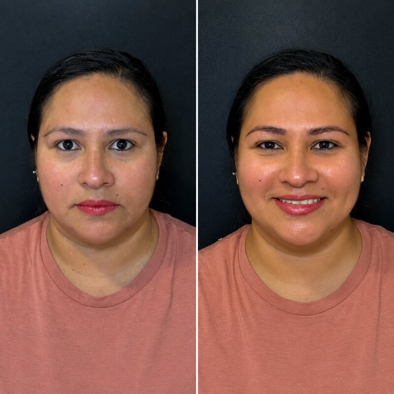 Resultado real de micropigmentación de cejas, caso 5