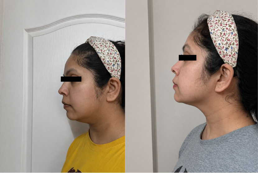 Double chin gone before & after
