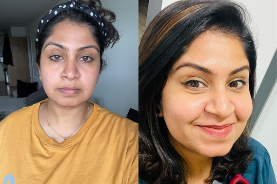 Open pores before & after