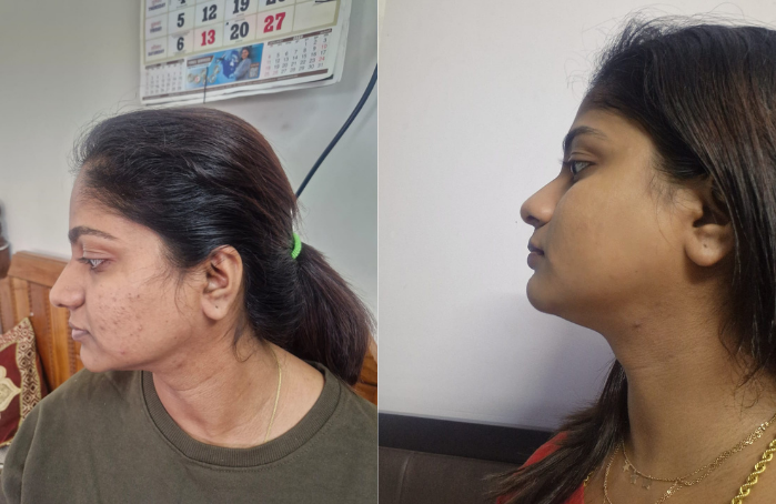 Acne before & after