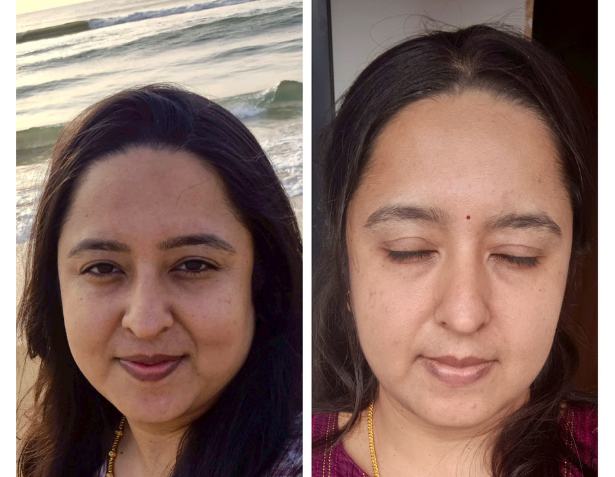 Jawline before & after