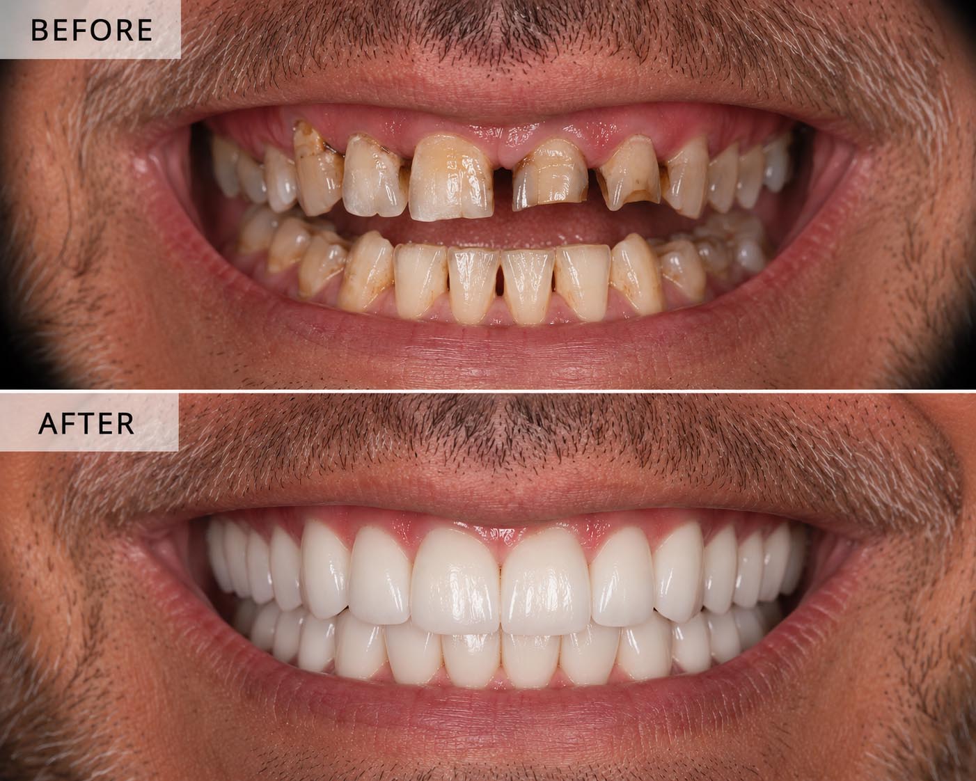 Before and after dental implants 1