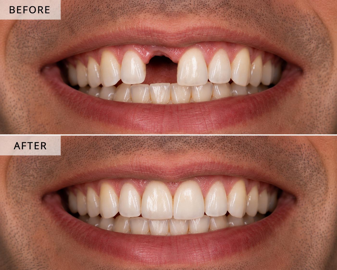 Before and after dental implants 3