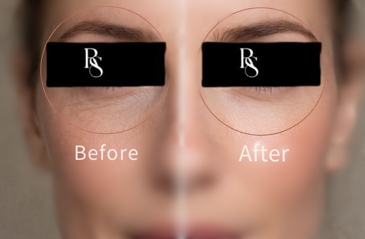Doctor-led under eye treatment Johannesburg consultation at Radiant Secrets Illovo Doctor-led under eye treatment Johannesburg consultation at Radiant Secrets Illovo