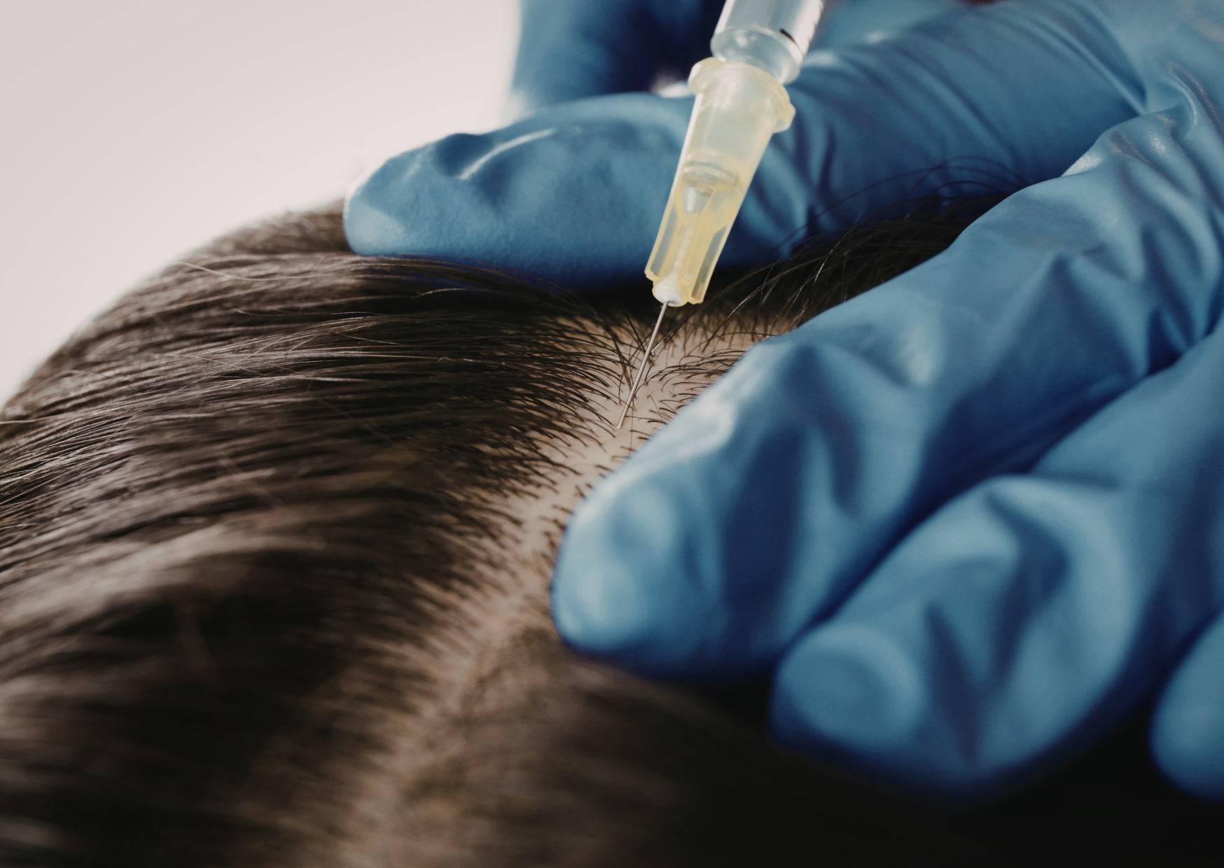 Non-Surgical Hair Replacement