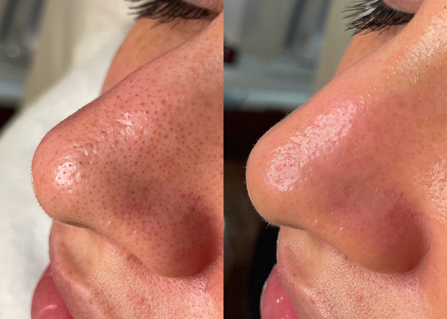 HydraFacial before and after result