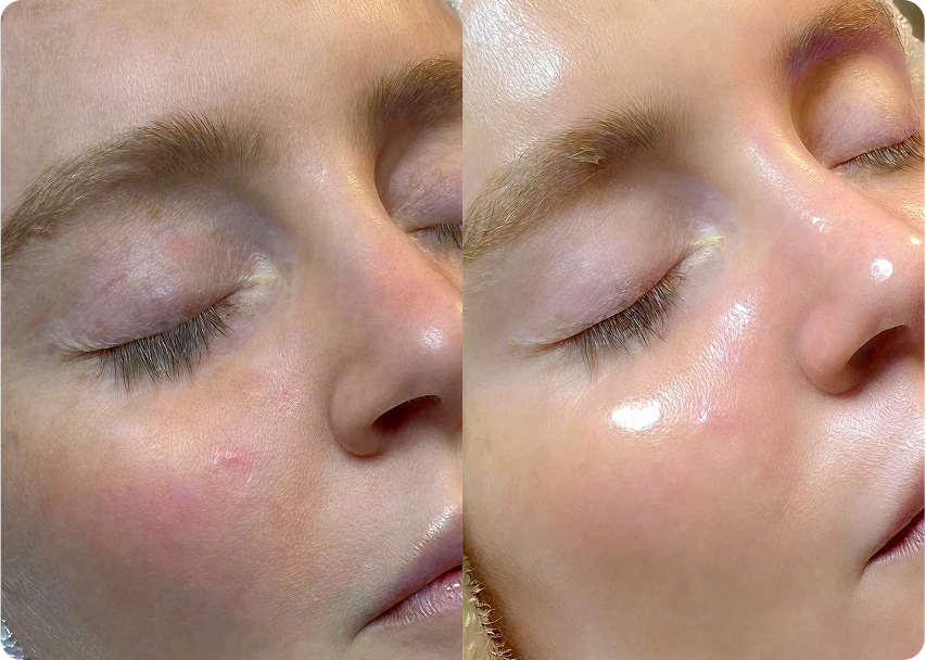 HydraFacial before and after result
