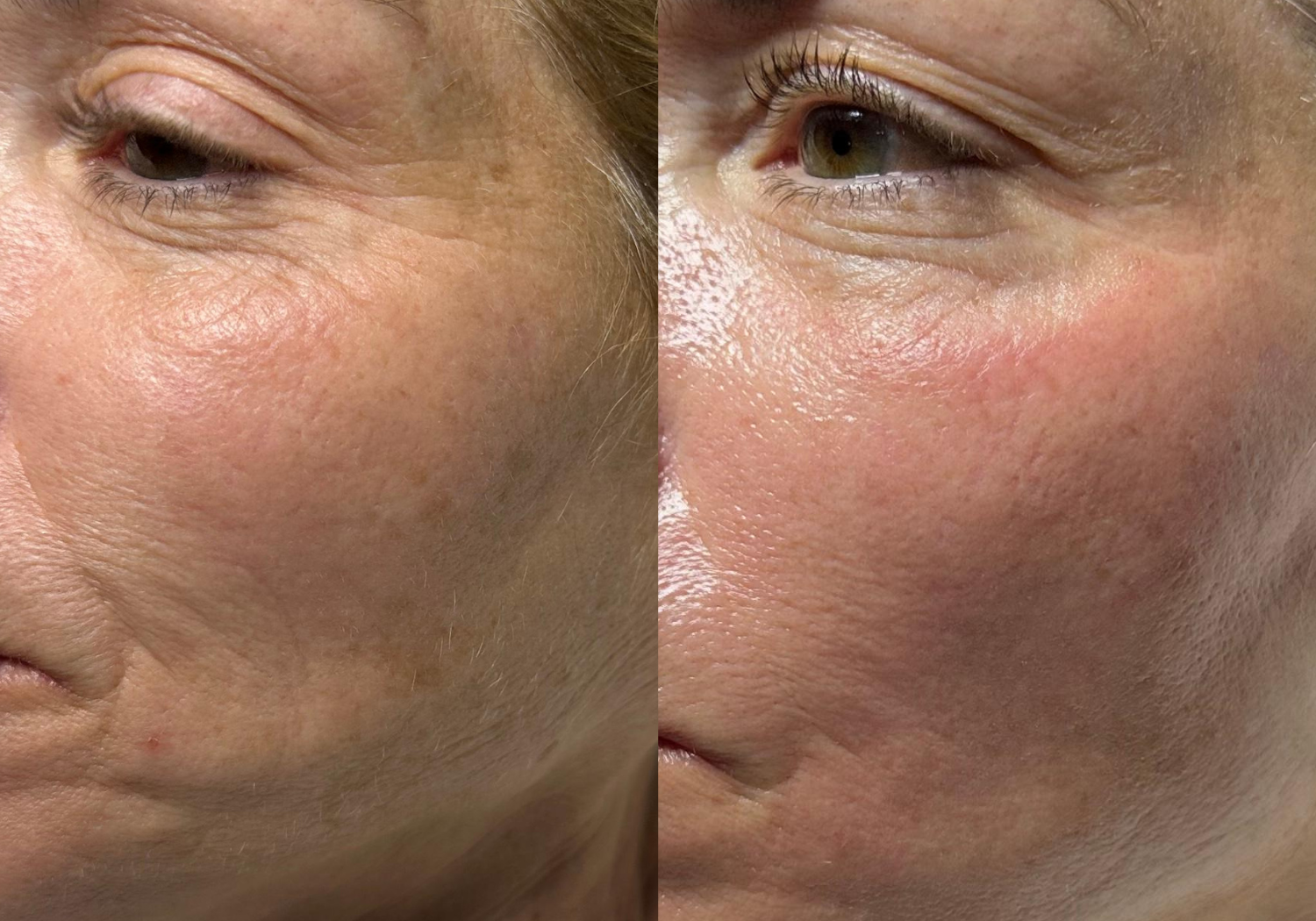 HydraFacial before and after result