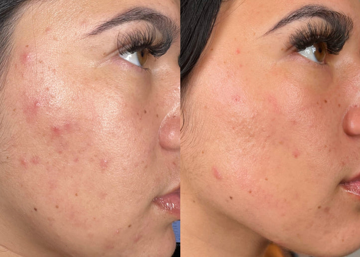 HydraFacial before and after result