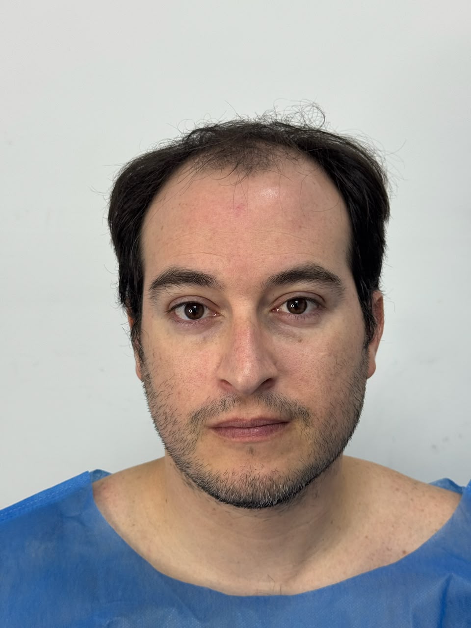Paciente 3 — antes del trasplante capilar