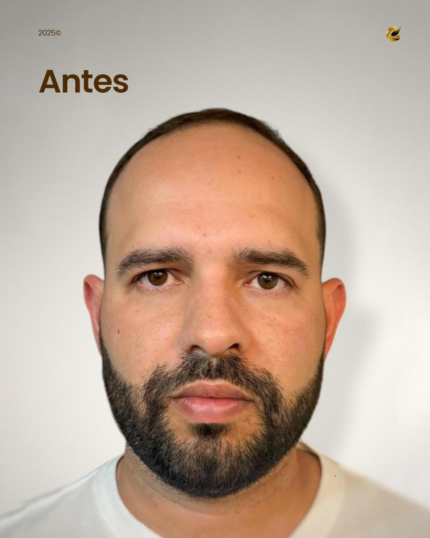 Paciente 1 — antes del trasplante capilar