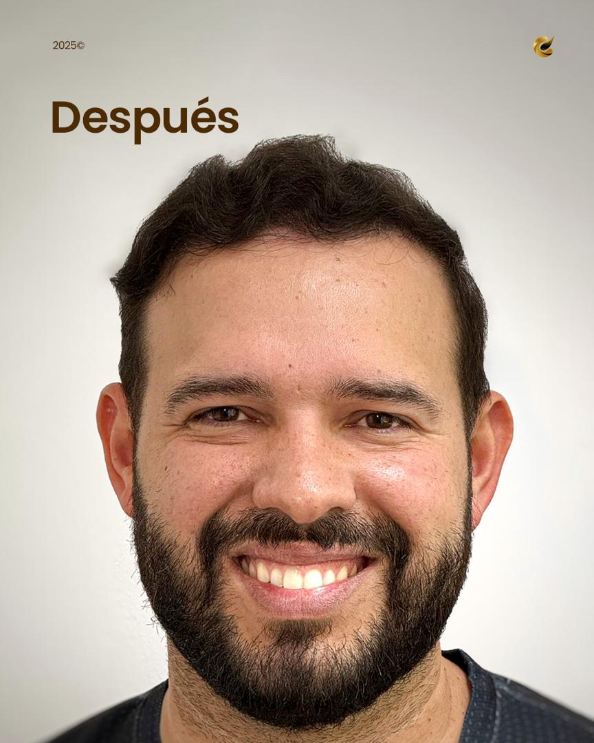 Paciente 1 — después del trasplante capilar