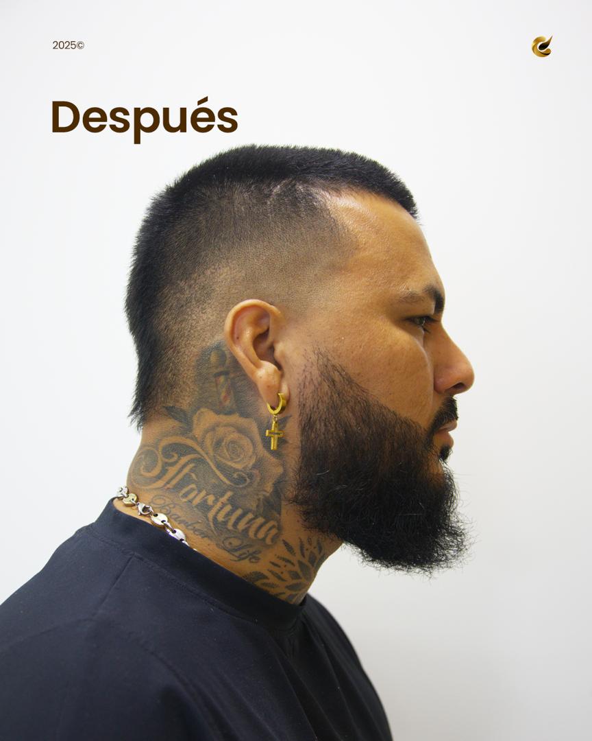 Paciente 2 — después del trasplante capilar