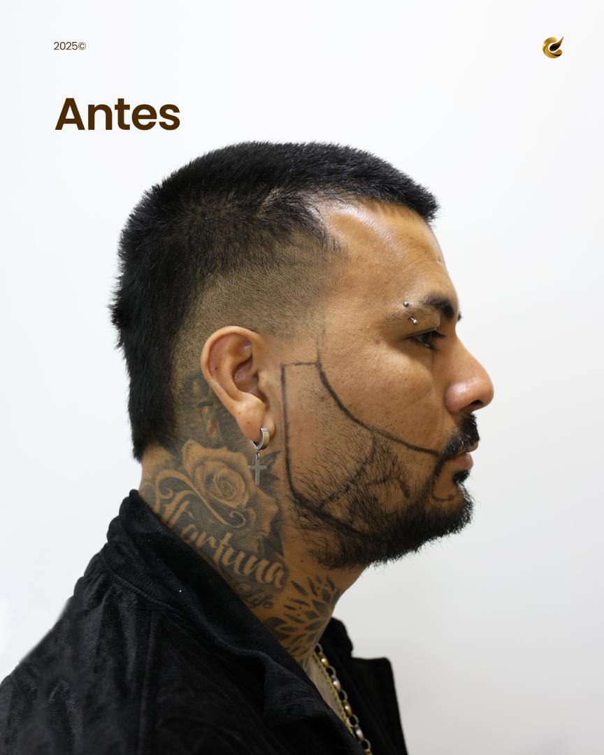 Paciente 2 — antes del trasplante capilar