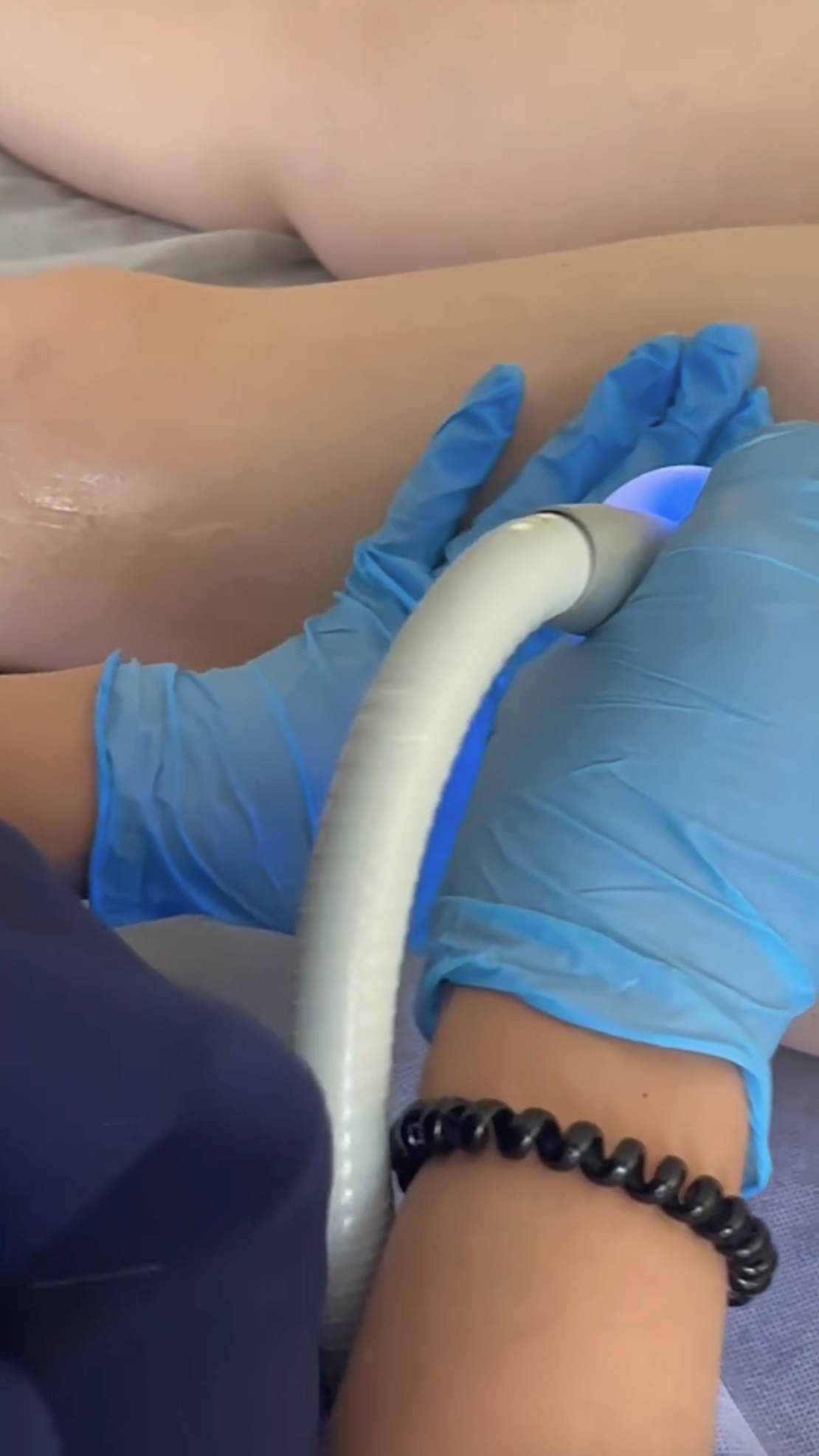 CryoSkin treatment at MG Wellness