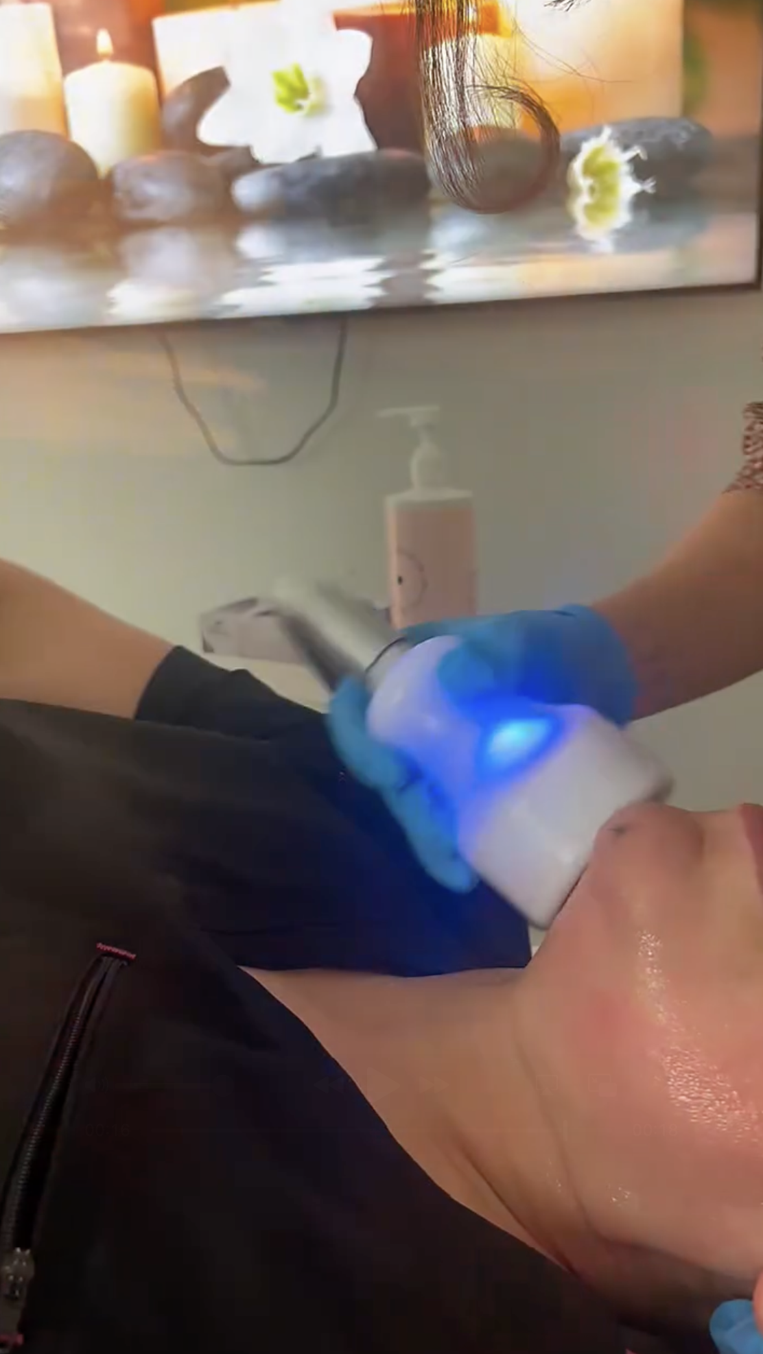 CryoSkin treatment