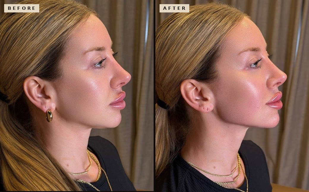 Facial Balancing before and after