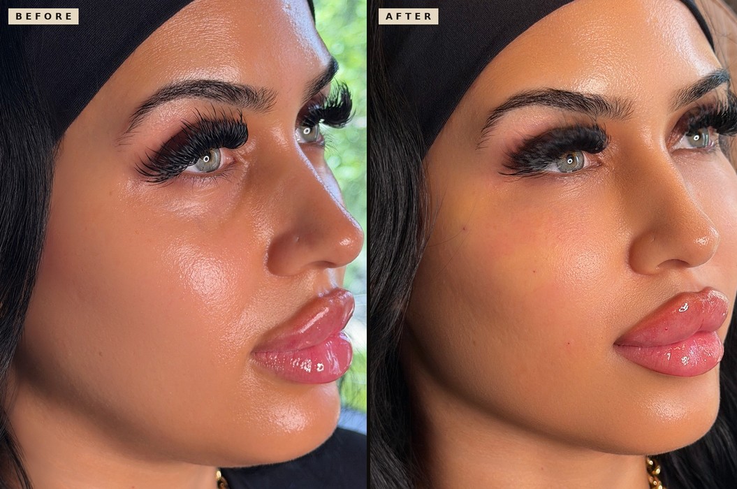 Selphyl under eyes before and after