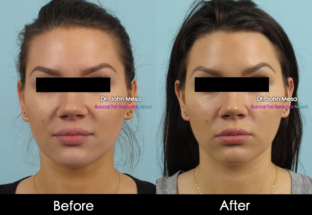 Buccal fat removal before and after female patient oblique view - Dr. John Mesa MD Miami