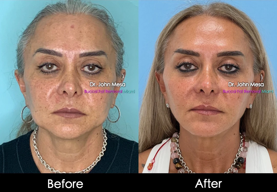 Buccal fat removal before and after female patient oblique view - Dr. John Mesa MD Miami