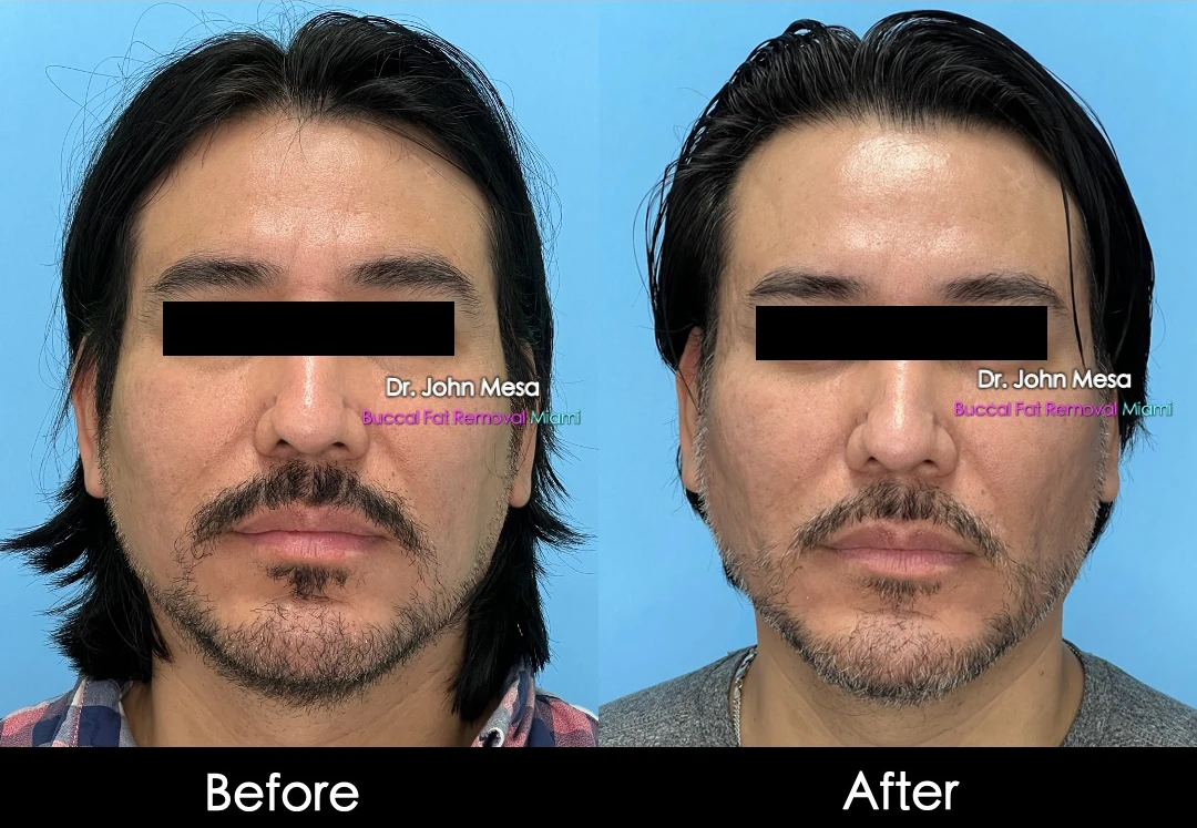 Buccal fat removal before and after female patient oblique view - Dr. John Mesa MD Miami