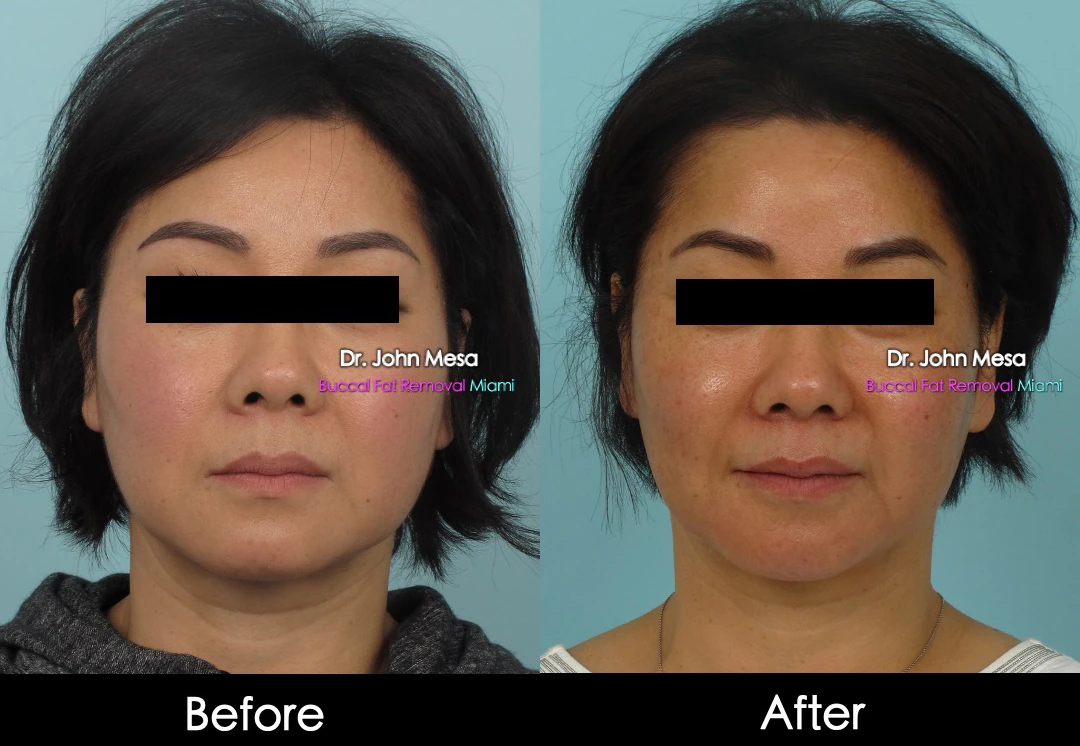 Buccal fat removal before and after female patient oblique view - Dr. John Mesa MD Miami