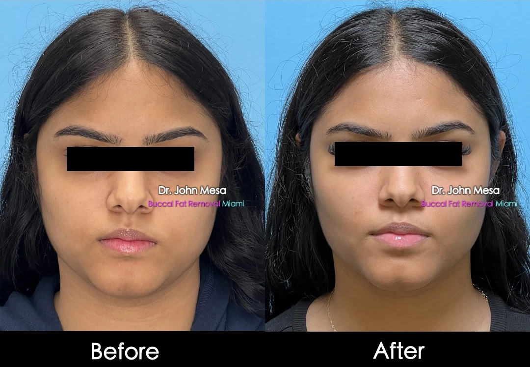 Buccal fat removal before and after female patient front view - Dr. John Mesa MD Miami