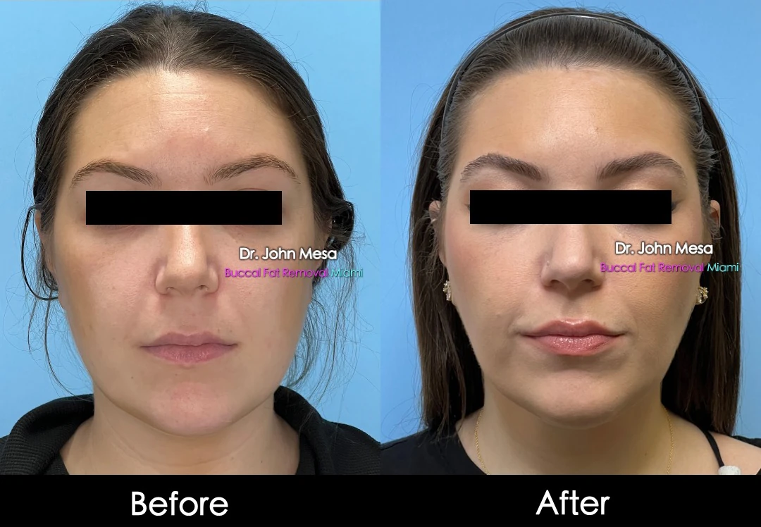 Buccal fat removal before and after female patient oblique view - Dr. John Mesa MD Miami