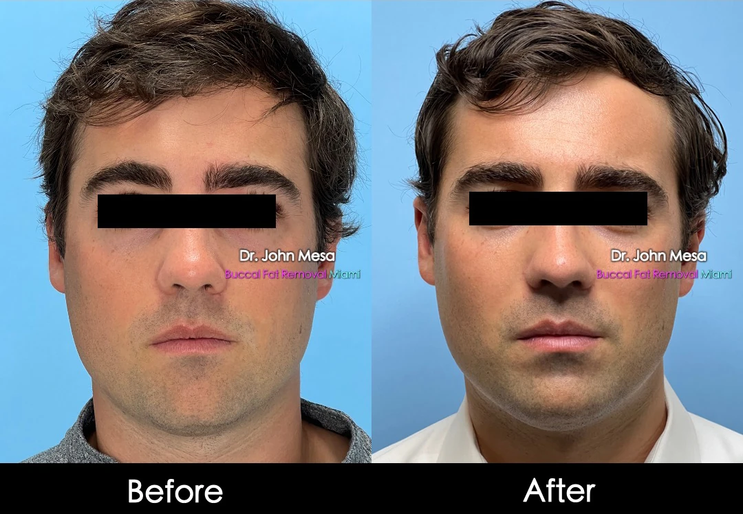 Buccal fat removal before and after male patient oblique view - Dr. John Mesa MD Miami