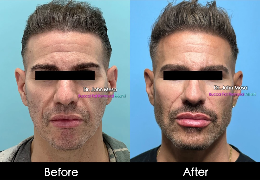 Buccal fat removal before and after female patient front view - Dr. John Mesa MD Miami