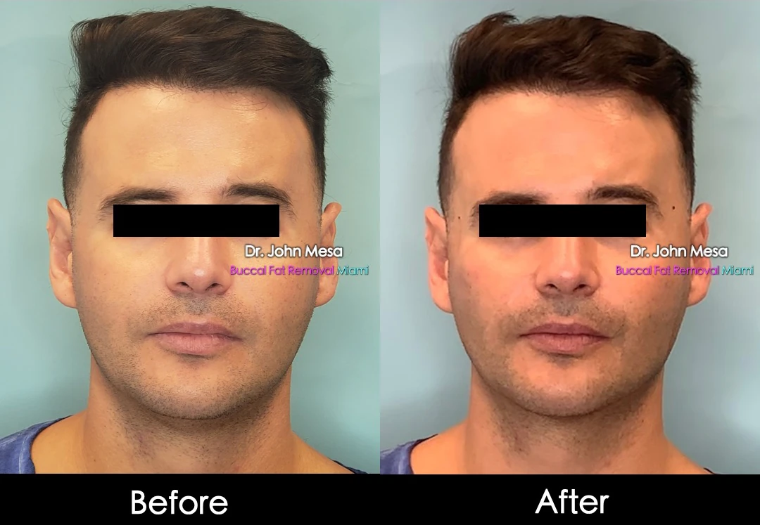 Buccal fat removal before and after female patient front view - Dr. John Mesa MD Miami