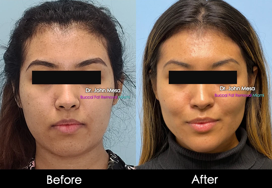 Buccal fat removal before and after female patient front view - Dr. John Mesa MD Miami