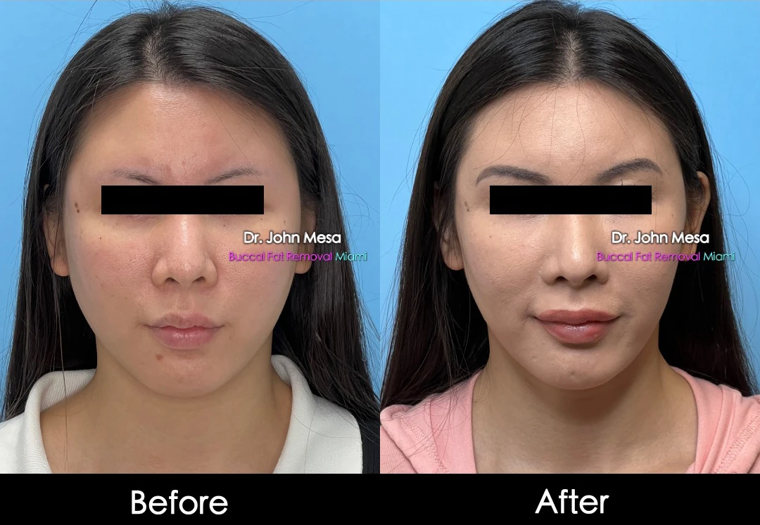 Buccal fat removal before and after female patient oblique view - Dr. John Mesa MD Miami