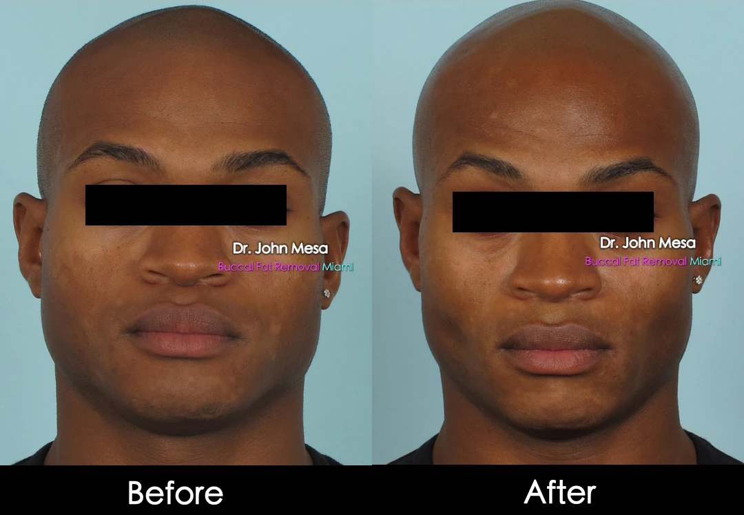 Buccal fat removal before and after male patient front view - Dr. John Mesa MD Miami