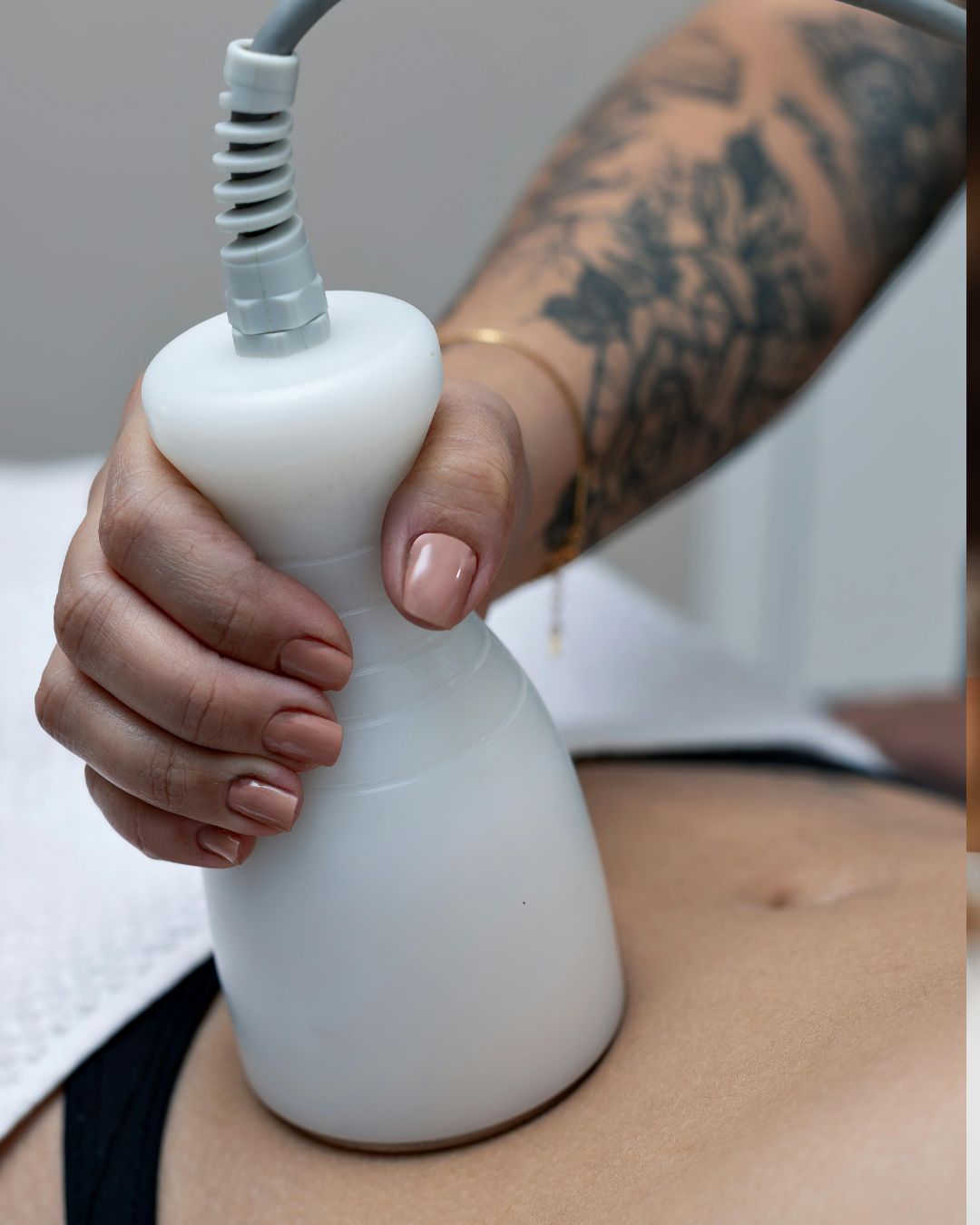 NeveSkin Shape body contouring treatment