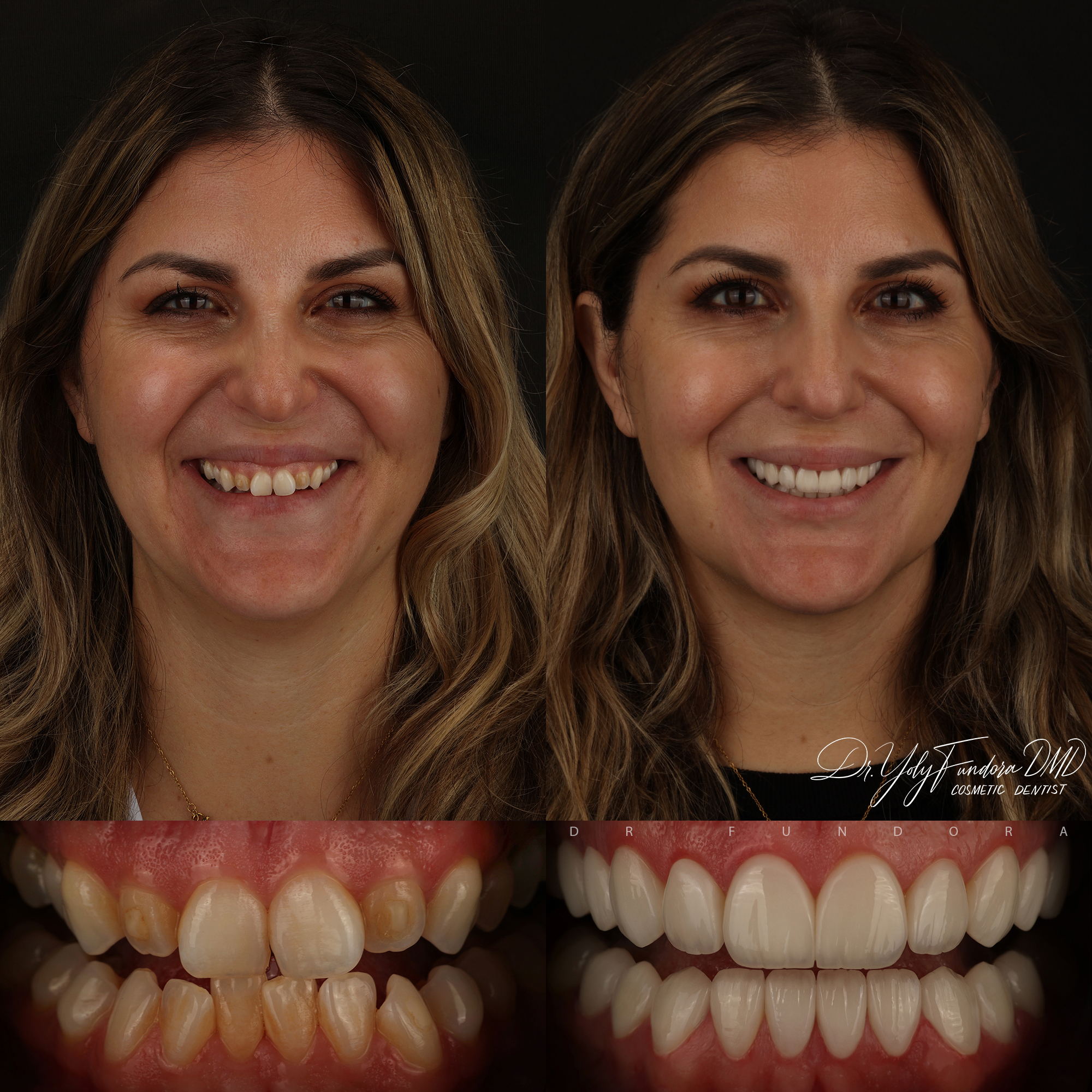 Crown Lengthening Veneers Before and After by Dr. Fundora - Whole Dental Design