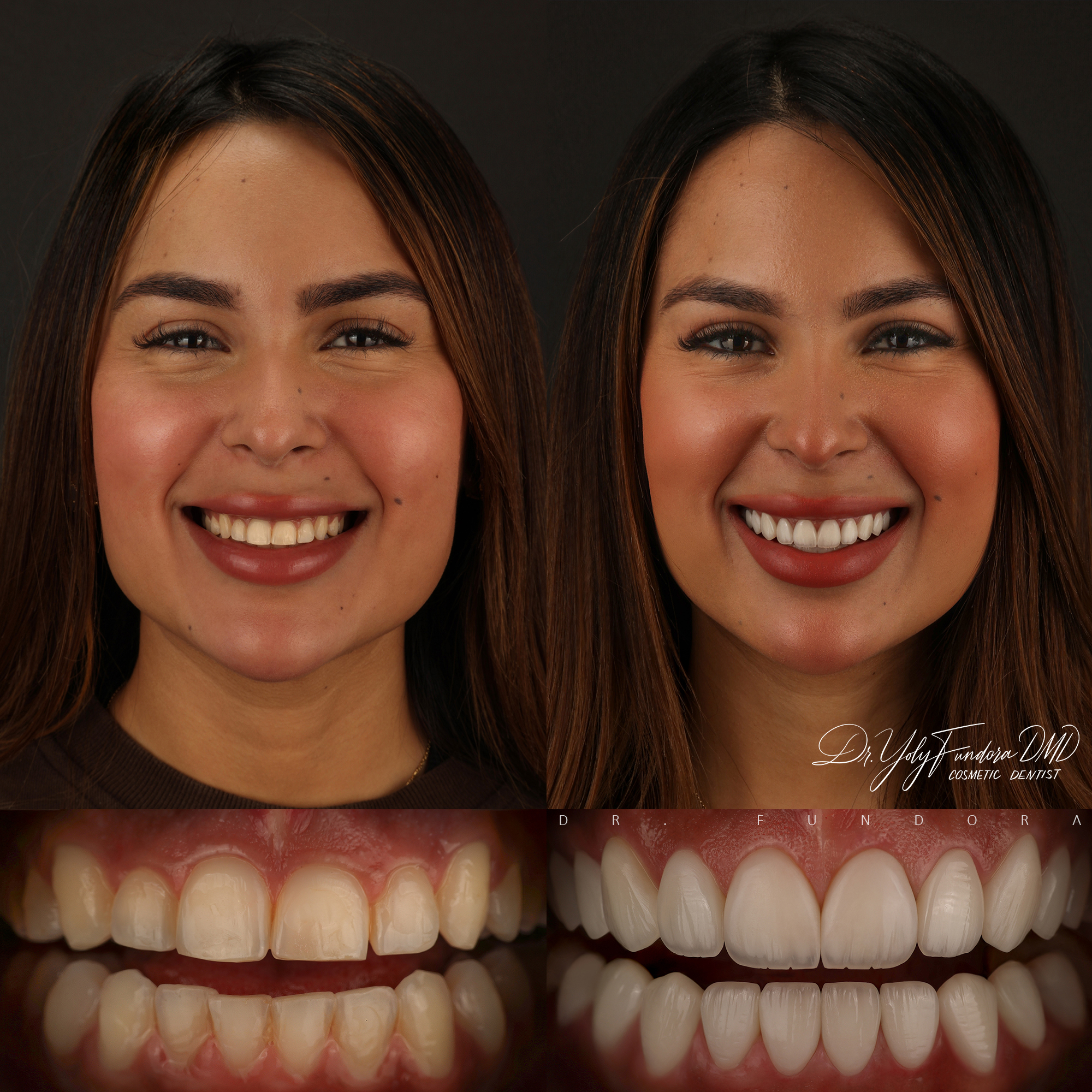 E-max Layered Veneers Before After Smile Transformation Dr. Fundora Whole Dental Design