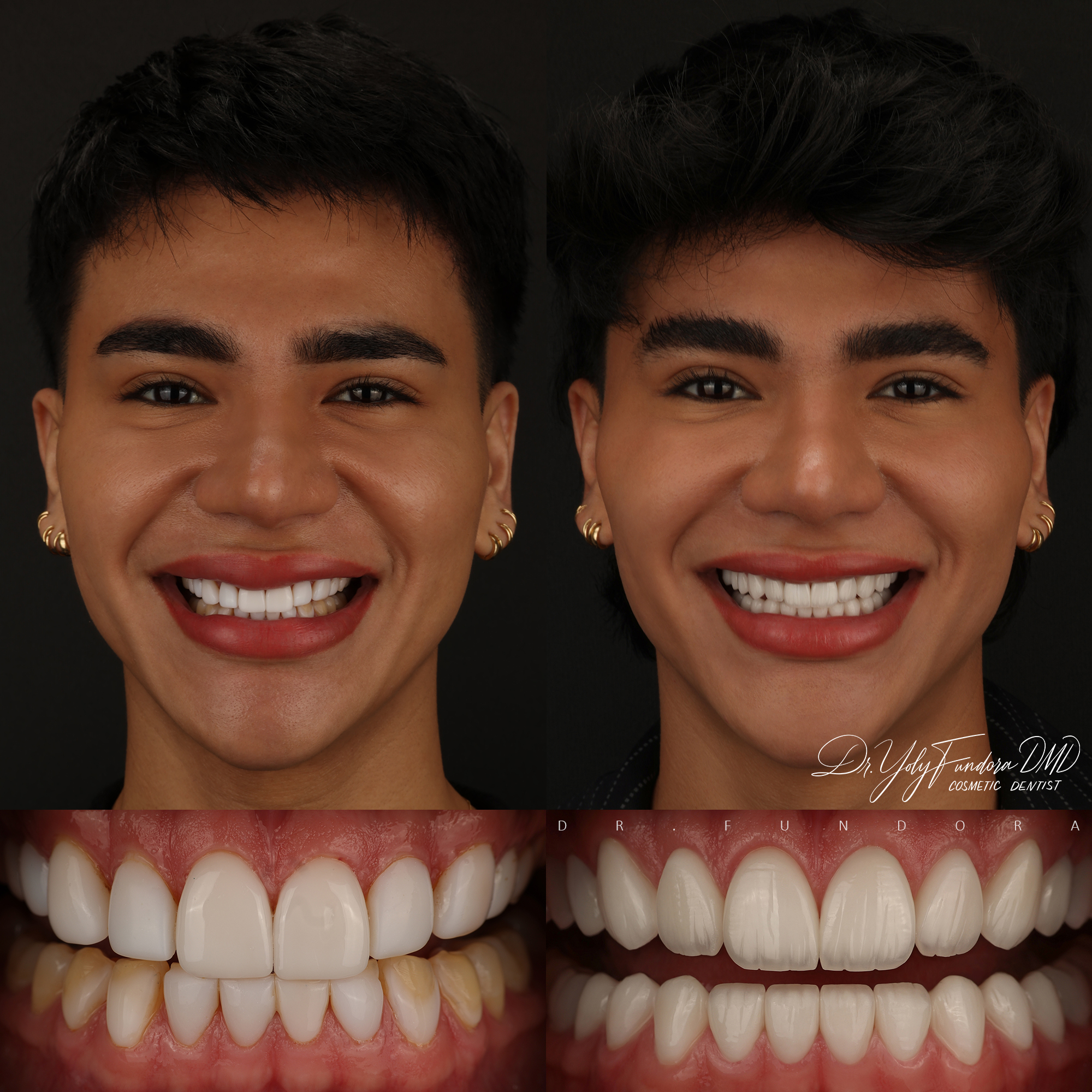 20 Translucent Veneers Before After E-max Layered Veneers Dr. Fundora Whole Dental Design