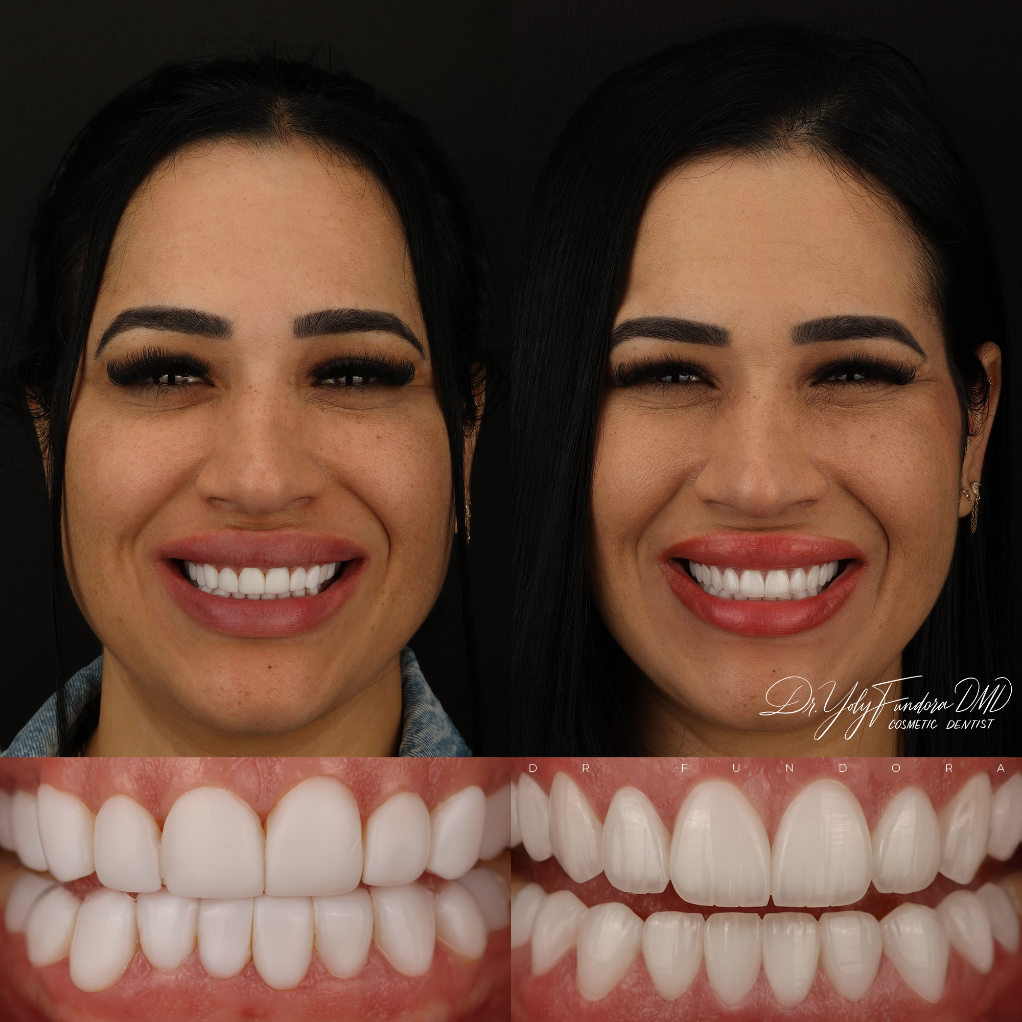 Crown Lengthening Veneers Before and After by Dr. Fundora - Whole Dental Design