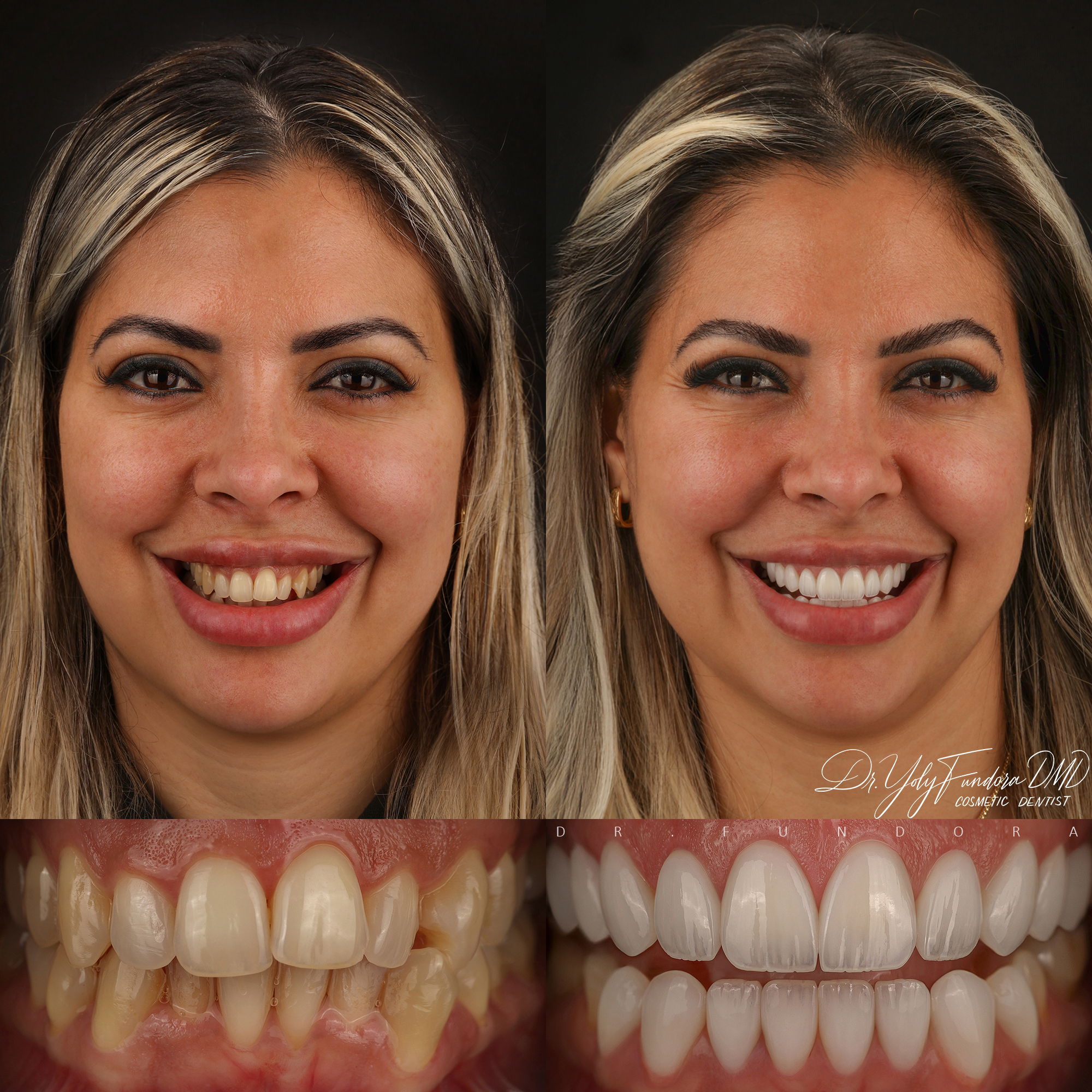 E-max Layered Veneers Before After Smile Transformation Dr. Fundora Whole Dental Design