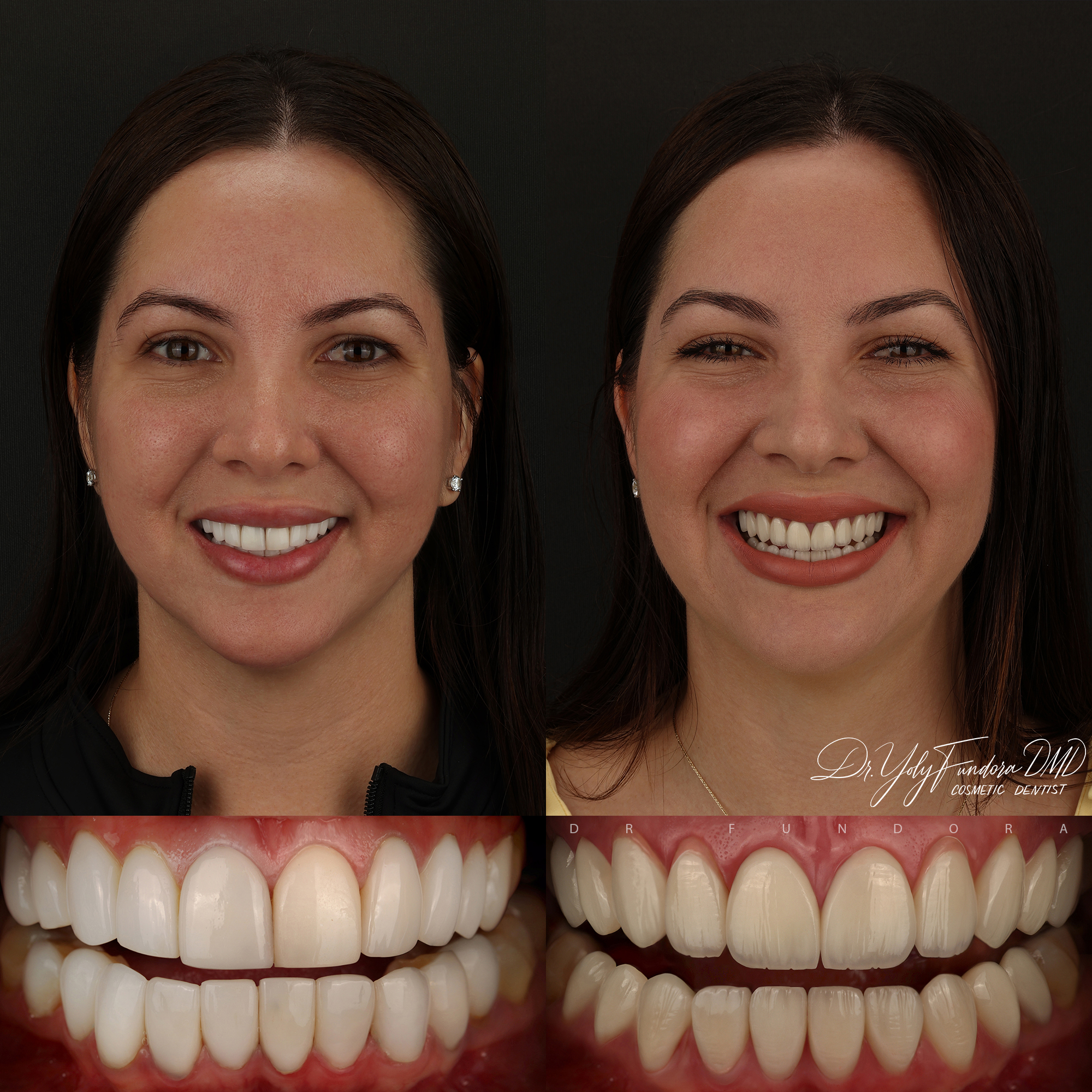 20 Translucent Veneers Before After E-max Layered Veneers Dr. Fundora Whole Dental Design
