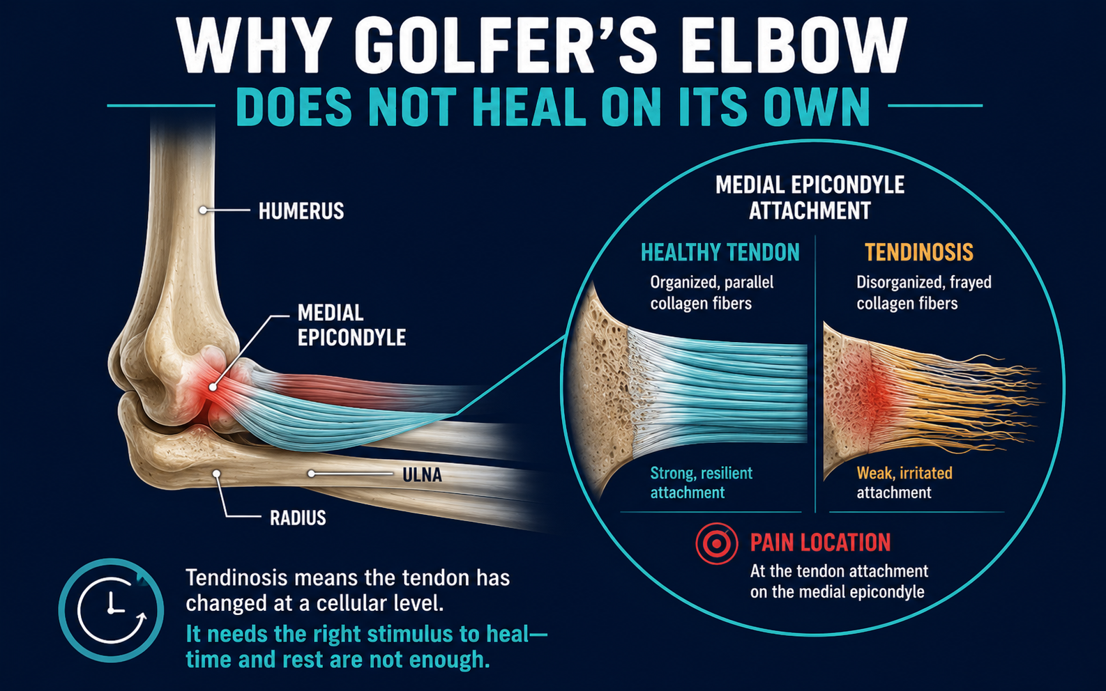 Labeled anatomical diagram of medial epicondylitis showing flexor tendon attachment and degeneration at the inner elbow